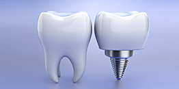 Implants