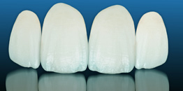 All-Ceramic Crowns